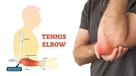 10 Early Symptoms Of Tennis Elbow Most People Ignore