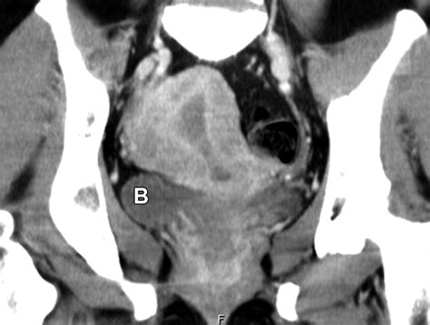 normal or abnormal demystifying uterine and cervical contrast