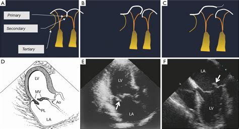 Standard Transthoracic Echocardiography And Transesophageal