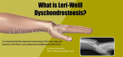 What Is Leri Weill Dyschondrosteosis Causes Symptoms Treatment Diagnosis