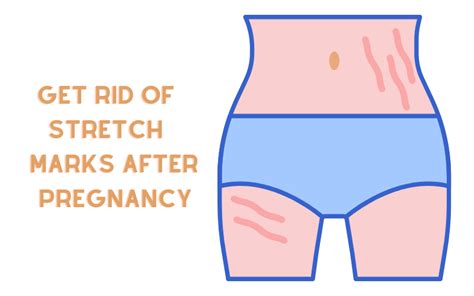How To Get Rid Of Stretch Marks After Pregnancy — Fair Play Canada