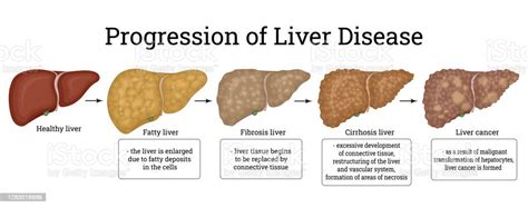Illustration Of The Stages Of Liver Damage Stock Illustration