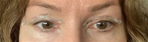 herstel na een ooglidcorrectie  beeld abc clinic