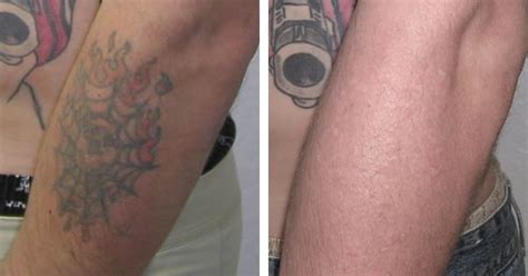 laser tattoo removal    pictures tattoo removal methods