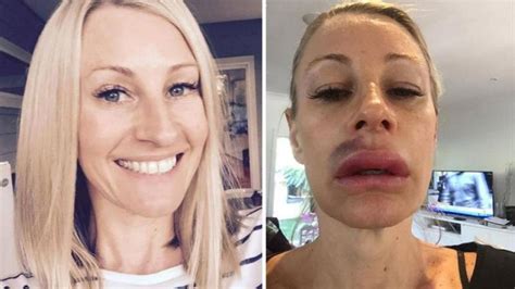 sydney mum s horror after lip fillers go badly wrong
