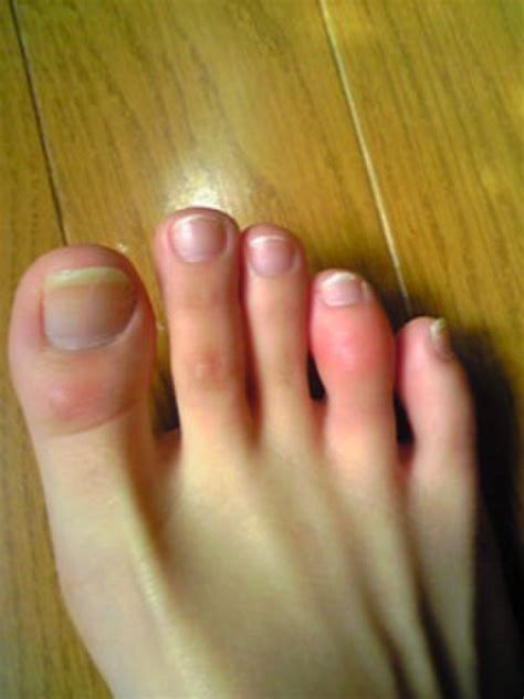 冬になると足の指が 冬になると足の薬指が画像のように腫れ Qanda Cosme アットコスメ