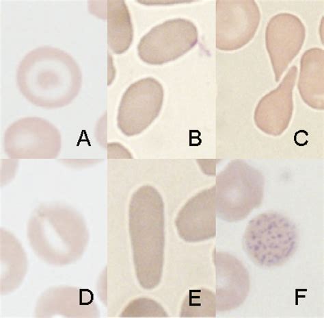 red blood cell morphology  patients   thalassemia minor