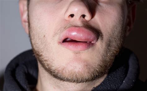Swollen Lips Causes Symptoms And Treatments – Vedix