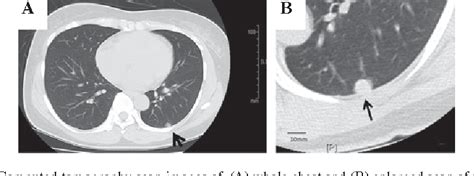 Figure 1 From Pulmonary Sclerosing Hemangioma With Lymph Node