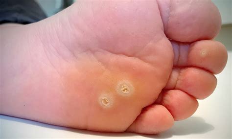warts removal melbourne wart diagnosis treatments