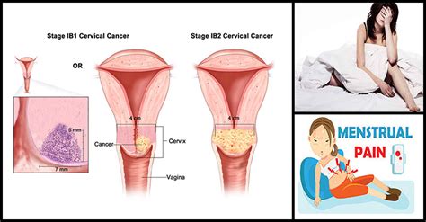 Cervical Cancer And Its Warning Signs Dr Farrah Md