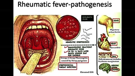 rheumatic fever usmle highly tested topic youtube