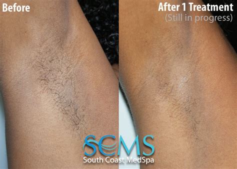 20 best images laser hair removal for black skin coolglide laser hair