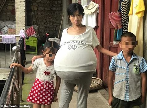 chinese woman s belly grows to 44lbs due to mystery condition daily