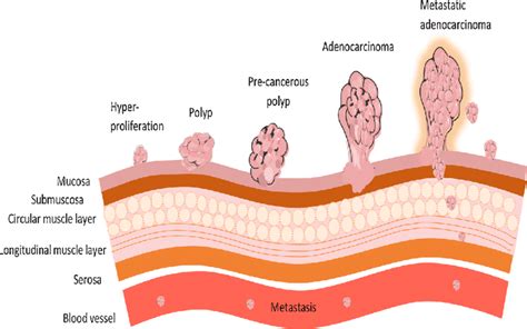 Stages Of Colorectal Cancer Hyperproliferation Of Epithelial Cells
