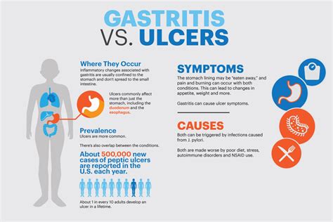 Gastritis Symptoms Types Treatment Causes Remedies Health Tips