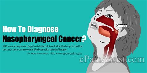How To Diagnose Nasopharyngeal Cancer And What Is The Best