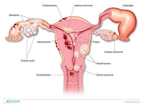 female reproductive system diseases sistema reproductor