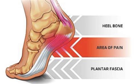 physical therapy  plantar fascia pain core omaha explains
