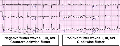 atrial flutter topic review