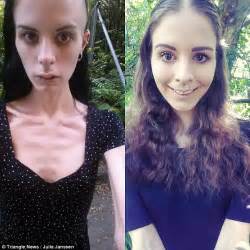 recovering anorexic from zurich hid food in her ears daily mail online