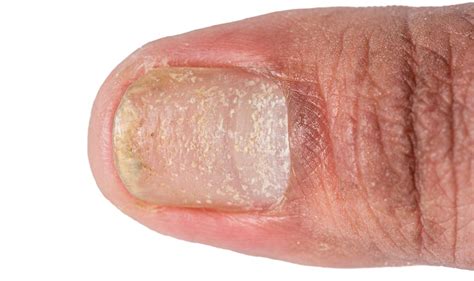 Nail Disease Mohave Dermatologymohave Dermatology