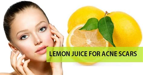 homeremedies to use lemon juice for acne scars pimple marks