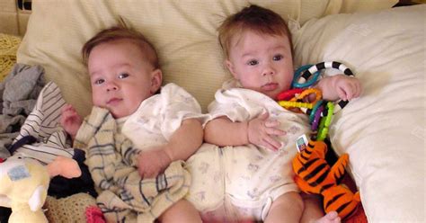 Conjoined Twins Defied The Odds Of Survival At Birth And