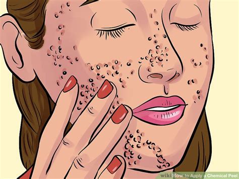 how to apply a chemical peel with pictures wikihow