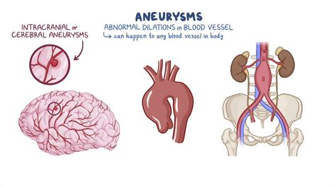 intracranial aneurysm nursing osmosis video library