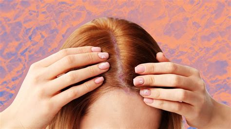 scalp psoriasis   treatment goodrx