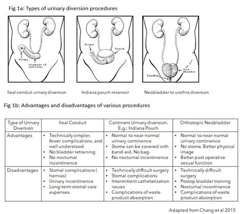 types of urinary diversion procedures ileal conduit
