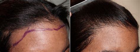 Hair Transplants For Women Pictures Miami Fl Paciente 71518