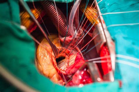Mitral Valve Repair Minimally Invasive Heart Surgery Vs