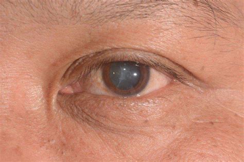 cataracts symptoms  treatment lions eye institute
