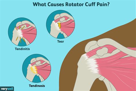 rotator cuff pain treatment symptoms