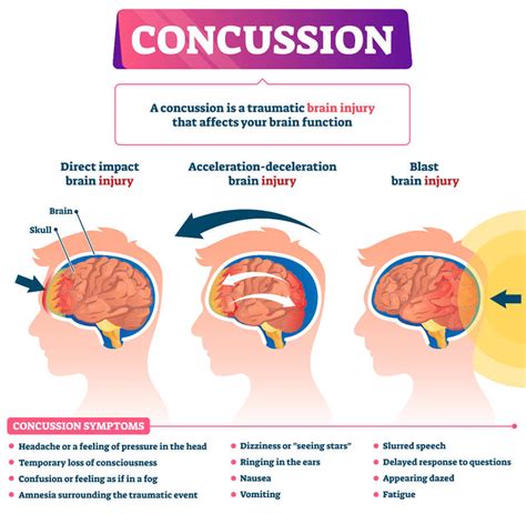 concussion  post concussion syndrome charlie waters law