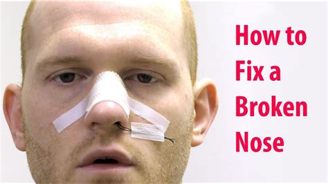 fix  broken nose  sedation closed nasal reduction