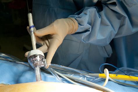 surgical mesh   hernia repair laparoscopicmd