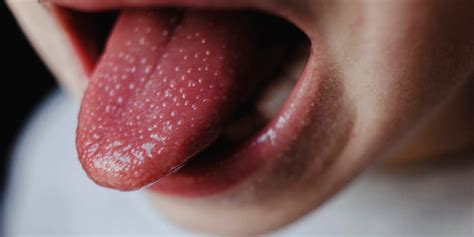 tongue bumps lie bumps canker sores and more