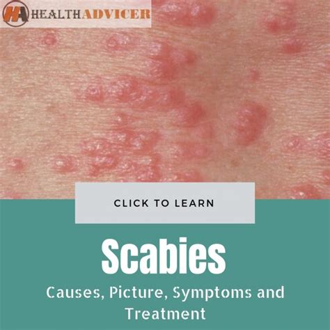 scabies causes picture symptoms and treatment