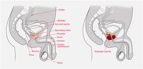 Prostate Cancer E J Whitten Foundation