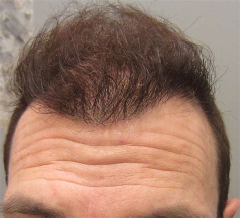 hair transplant post op pictures  yannick real transformation