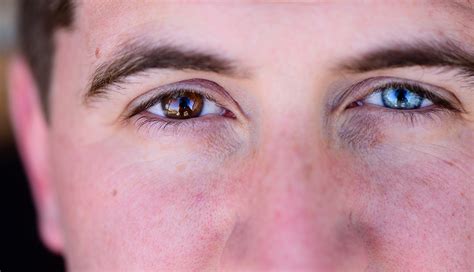What Can Having Different Colored Eyes Mean For Health
