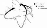 Coronary Stroke Ahajournals Atherosclerosis Carotid Acute Predict Vertebral Aortic sketch template