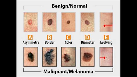 What To Look For During A Skin Cancer Self Exam