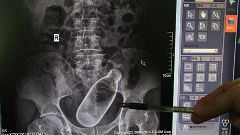 Shocking X Ray Shows Man With Glass Bottle Stuck Inside Him
