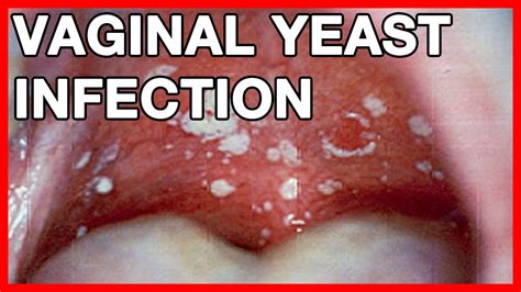 Stds Vaginal Yeast Infection Symptoms And Treatment Youtube