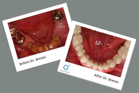 clean fixed dental implants dental news network