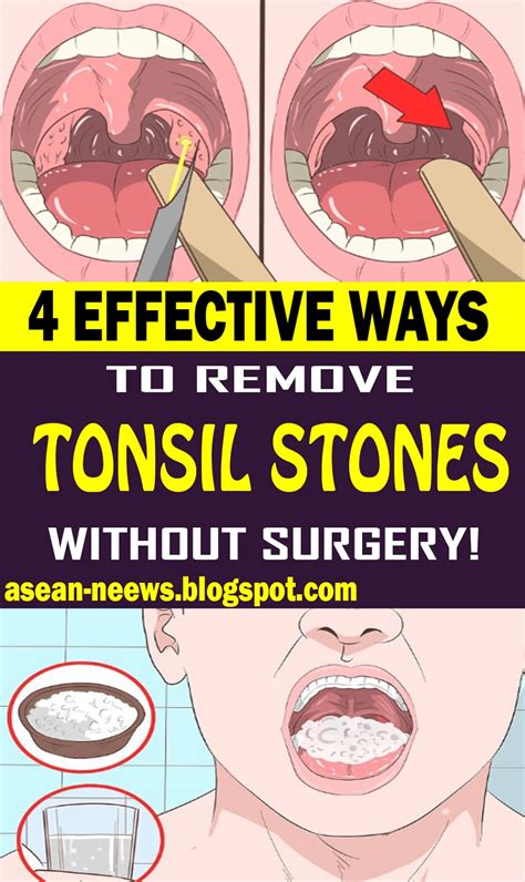 effective ways  remove tonsil stones  surgery health